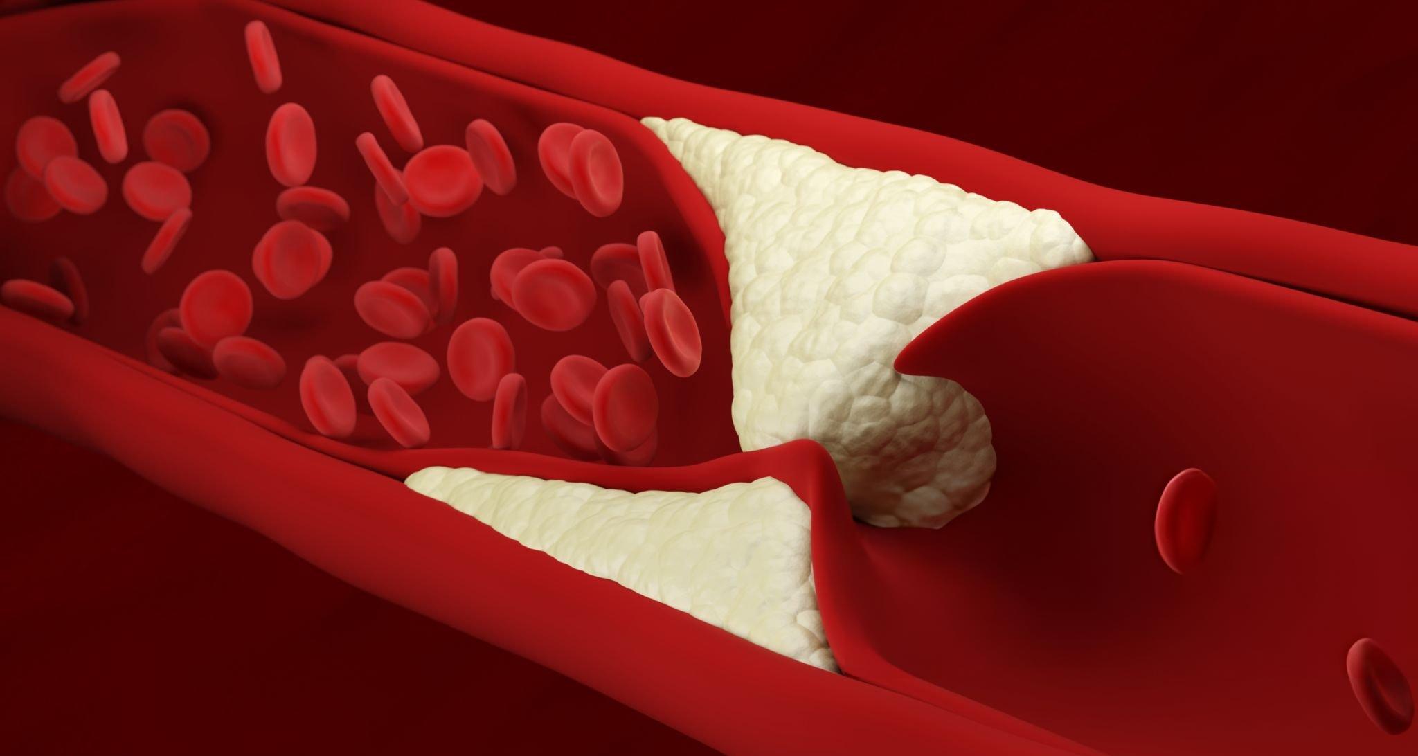 High Blood Cholesterol in Men